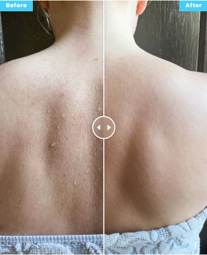Before and after back cleansing result